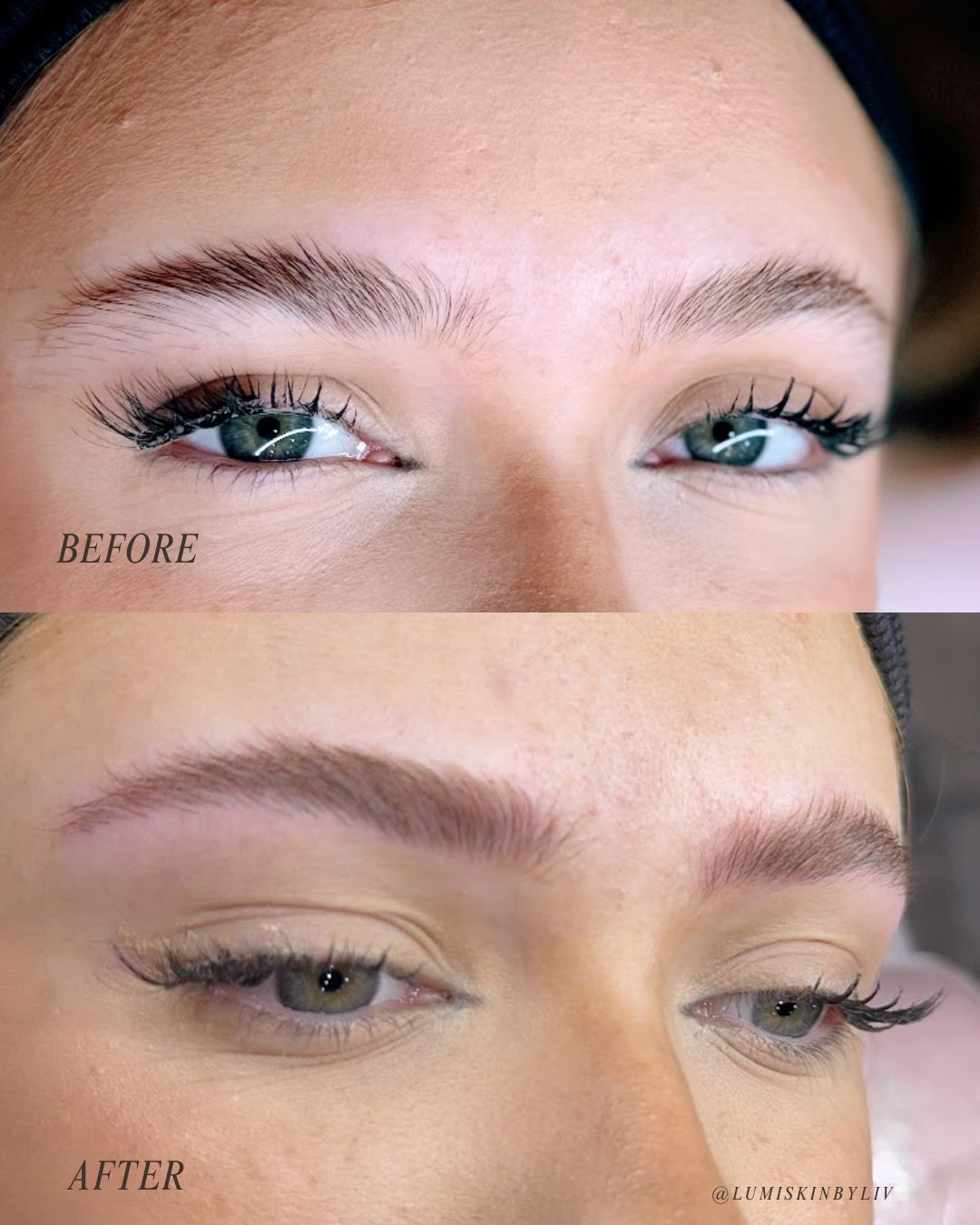 LumiSkin treatment result
