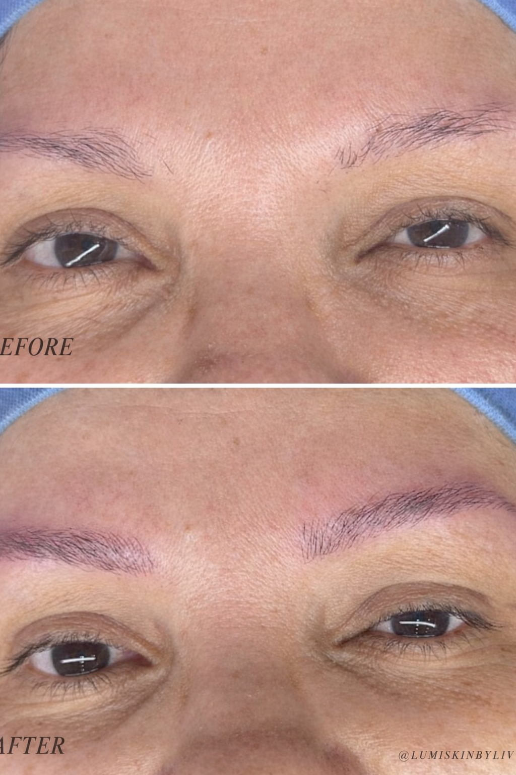 LumiSkin treatment result